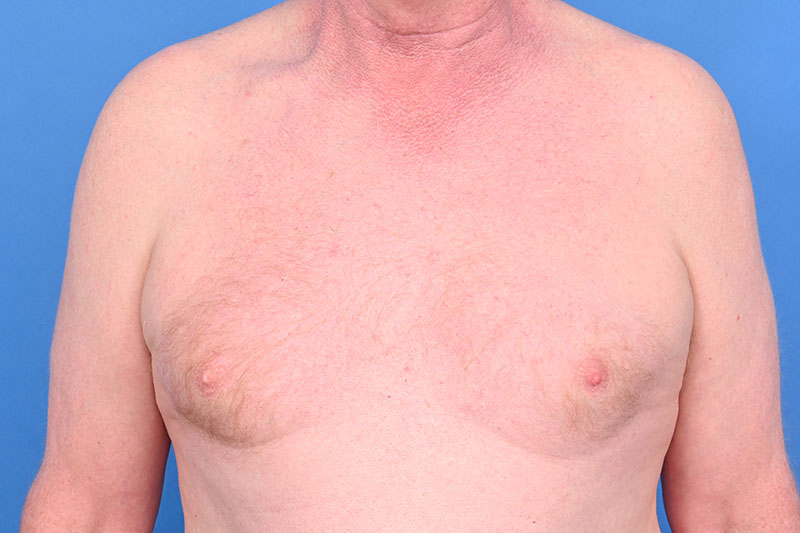 Patient Before & After Image