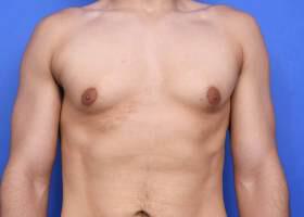 Patient Before & After Image