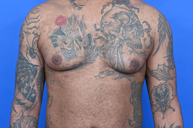 Revision Gynecomastia Surgery Before & After Image