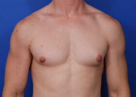 Austin Gynecomastia Surgery patient Before