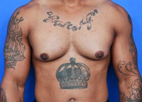 Austin Gynecomastia Surgery patient Before