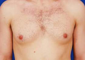Austin Gynecomastia Surgery patient Before