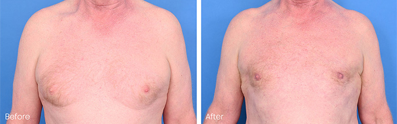 Advanced gynecomastia patient before treatment showing major sagging