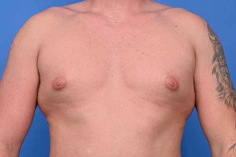 Patient Before & After Image