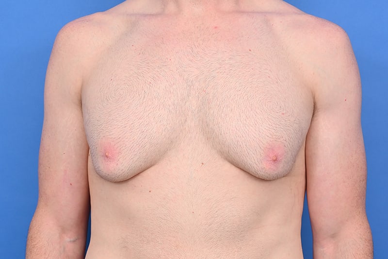 Patient Before & After Image