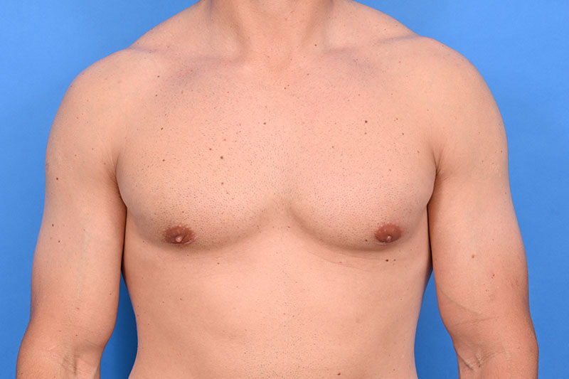 Patient Before & After Image