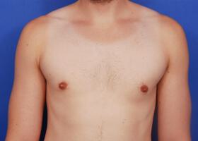 Patient Before & After Image