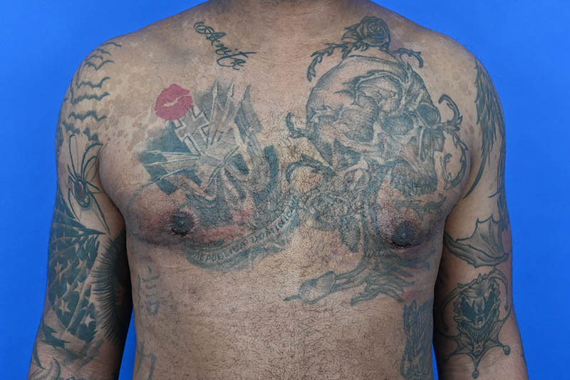 Revision Gynecomastia Surgery Before & After Image