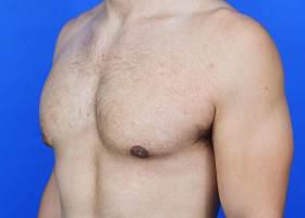 Revision Gynecomastia Surgery Before & After Image