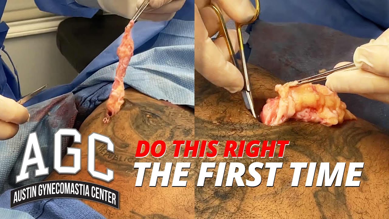 Removing tissue with Gynecomastia surgery video