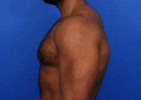 Austin Gynecomastia Surgery patient After
