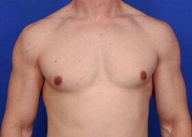 Austin Gynecomastia Surgery patient After