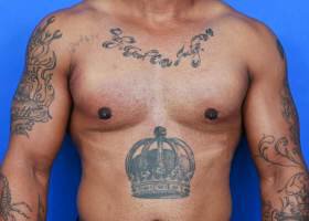 Austin Gynecomastia Surgery patient After
