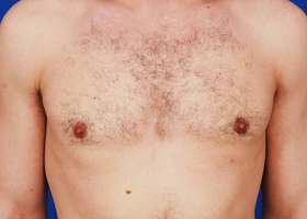 Austin Gynecomastia Surgery patient After