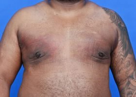 Austin Gynecomastia Surgery patient After