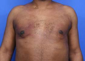 Austin Gynecomastia Surgery patient After