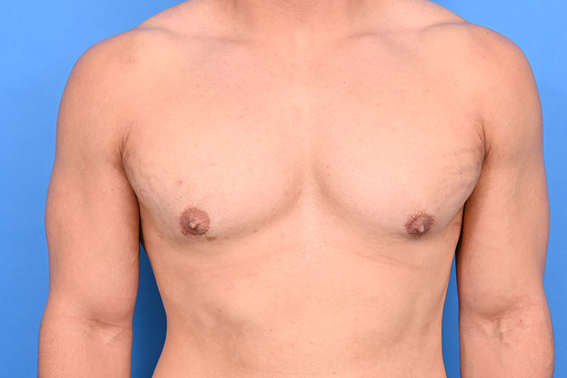 Gynecomastia Surgery Before & After Image