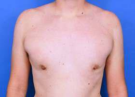 Patient Before & After Image