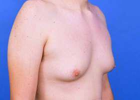 Gynecomastia Surgery Before & After Image