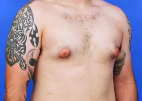 Gynecomastia Surgery Before & After Image