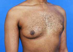 Gynecomastia Surgery Before & After Image