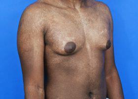 Gynecomastia Surgery Before & After Image