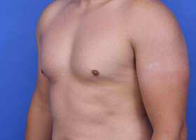 Gynecomastia Surgery Before & After Image