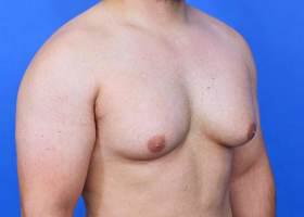 Gynecomastia Surgery Before & After Image