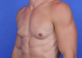 Gynecomastia Surgery Before & After Image