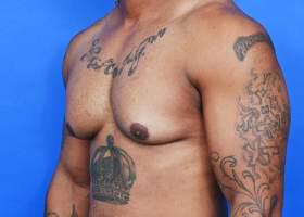 Gynecomastia Surgery Before & After Image