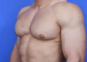 Gynecomastia Surgery Before & After Image