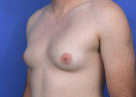 Gynecomastia Surgery Before & After Image