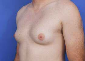 Gynecomastia Surgery Before & After Image