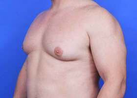Gynecomastia Surgery Before & After Image