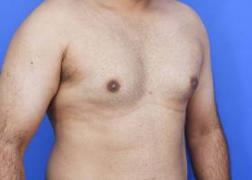 Gynecomastia Surgery Before & After Image