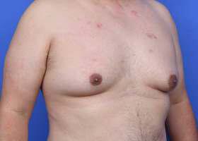Gynecomastia Surgery Before & After Image