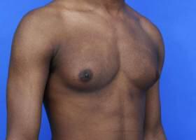 Gynecomastia Surgery Before & After Image