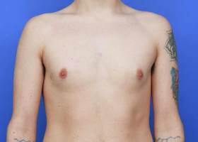 Gynecomastia Surgery Before & After Image
