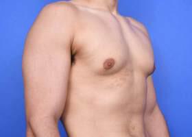 Gynecomastia Surgery Before & After Image