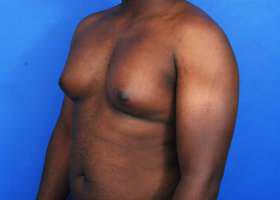 Gynecomastia Surgery Before & After Image