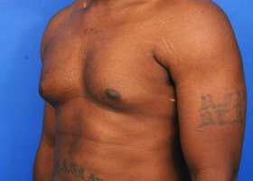 Gynecomastia Surgery Before & After Image