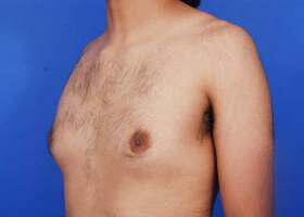 Gynecomastia Surgery Before & After Image