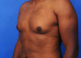 Gynecomastia Surgery Before & After Image
