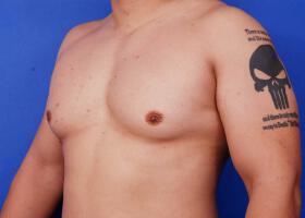 Gynecomastia Surgery Before & After Image