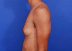 Gynecomastia Surgery Before & After Image
