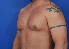 Gynecomastia Surgery Before & After Image