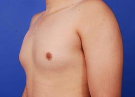 Gynecomastia Surgery Before & After Image