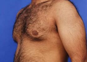 Gynecomastia Surgery Before & After Image