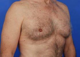 Gynecomastia Surgery Before & After Image