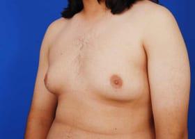 Gynecomastia Surgery Before & After Image